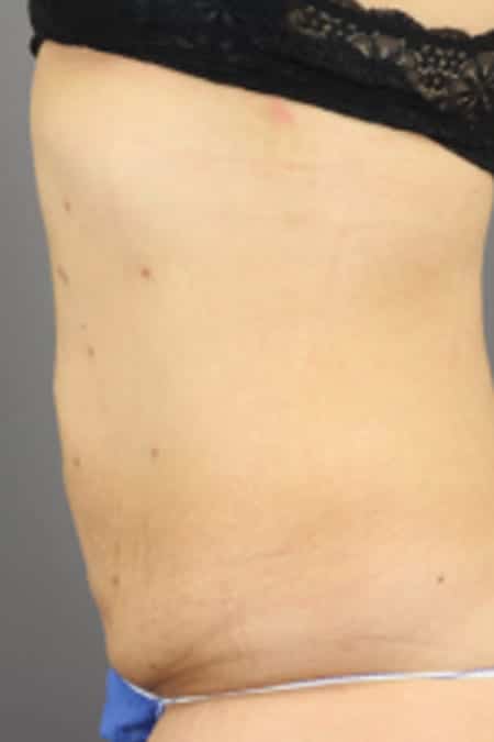 CoolSculpting Before and After Pictures San Diego, CA