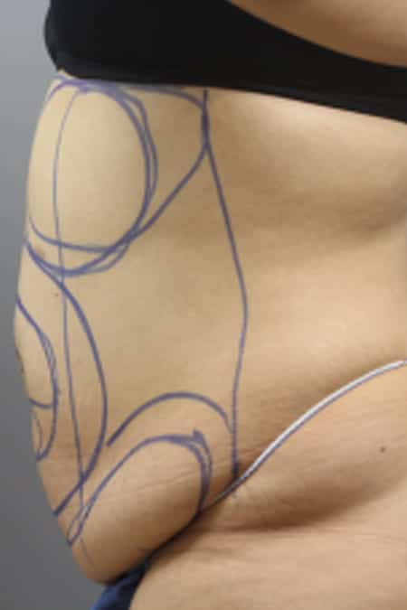 CoolSculpting Before and After Pictures San Diego, CA