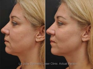 Ultherapy Before and After Pictures San Diego, CA