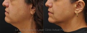 Ultherapy Before and After Pictures San Diego, CA