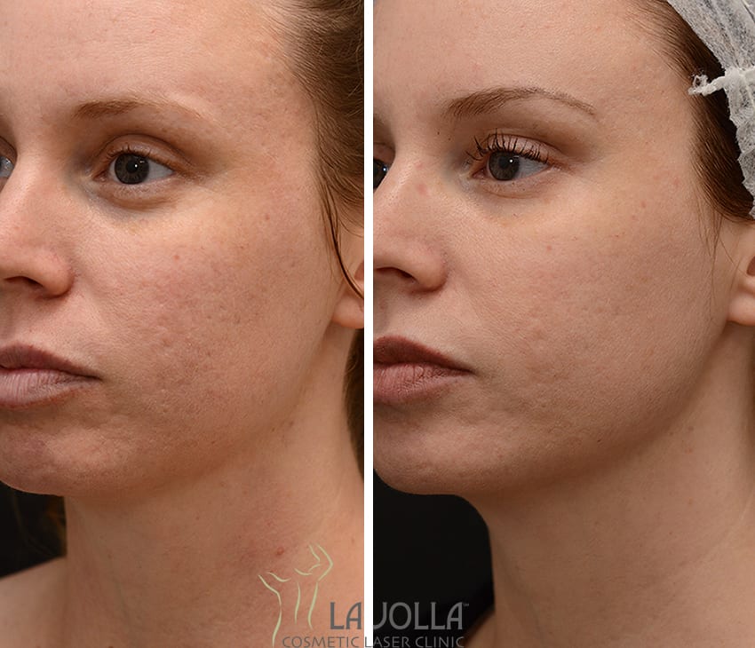 Acne Scars Before and After Pictures San Diego, CA