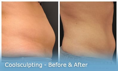 CoolSculpting Before and After Pictures San Diego, CA