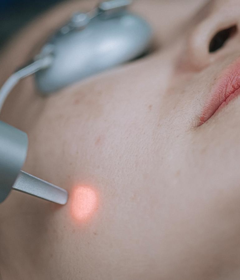 Fractional laser treatment | La Jolla Cosmetic Laser Clinic In San Diego