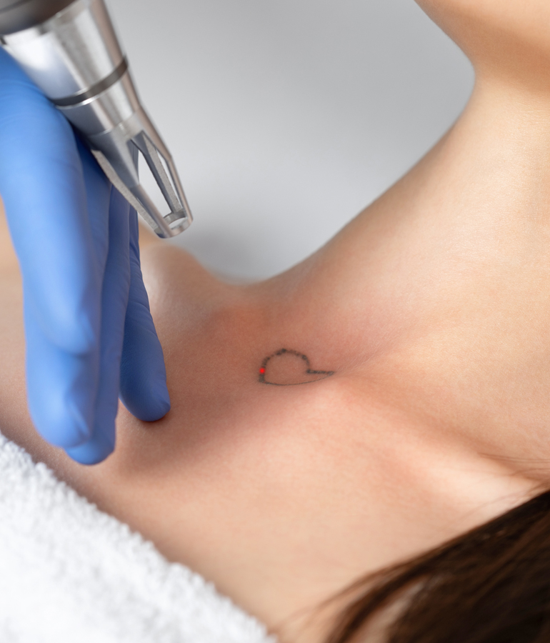 Tattoo removal laser | La Jolla Cosmetic Laser Clinic In San Diego