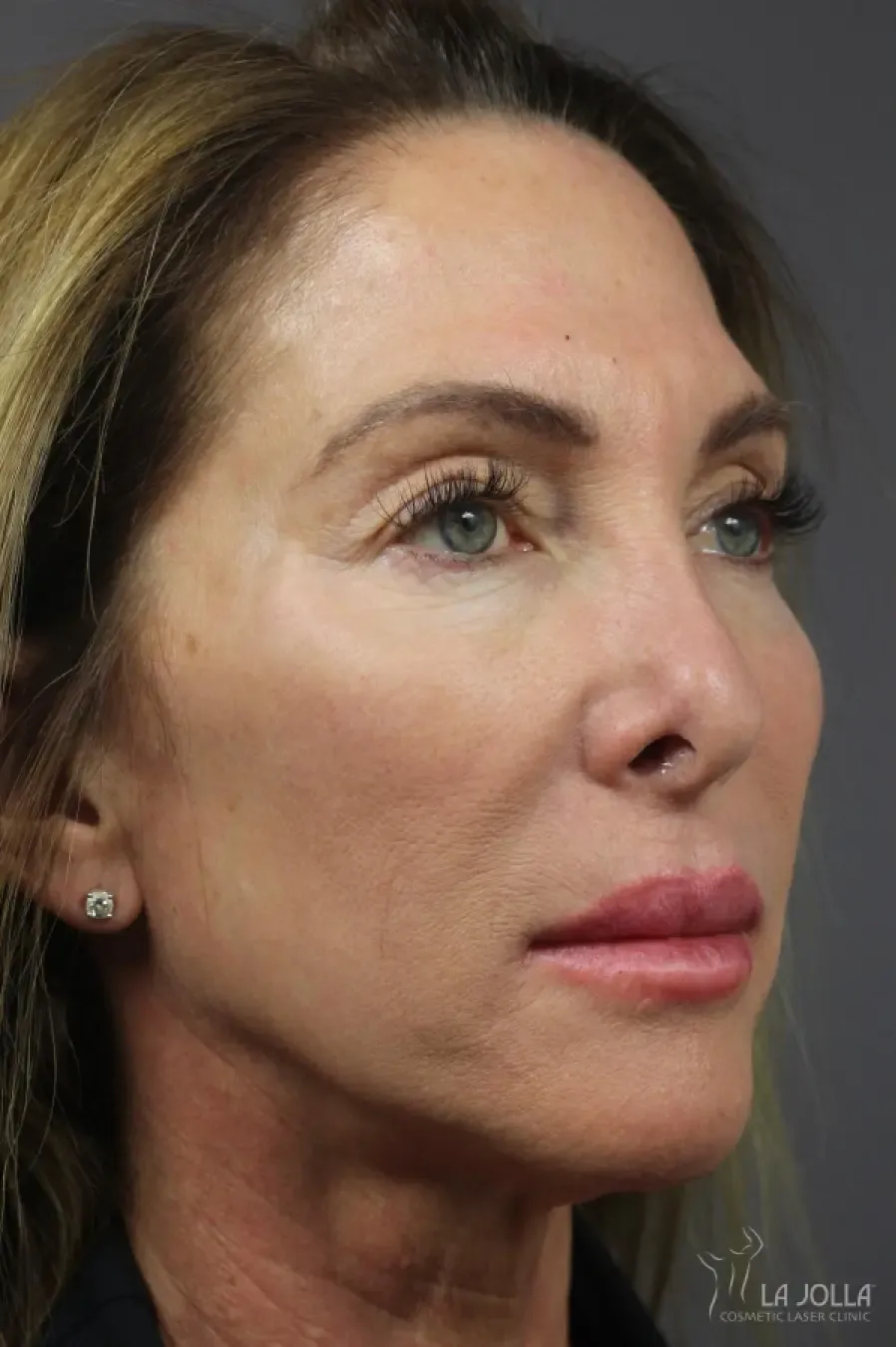 6D Platinum Laser Lift