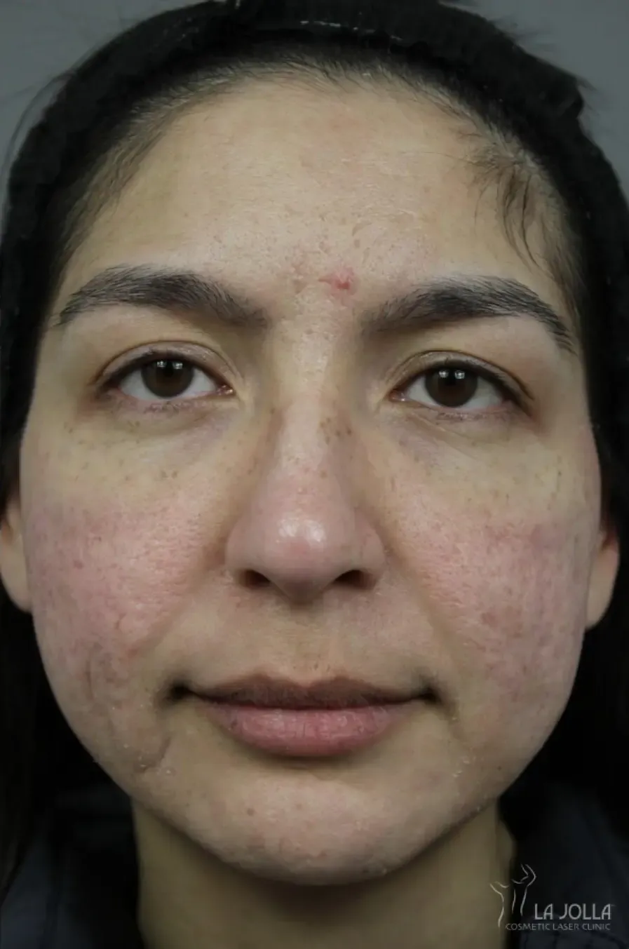 Acne Scarring