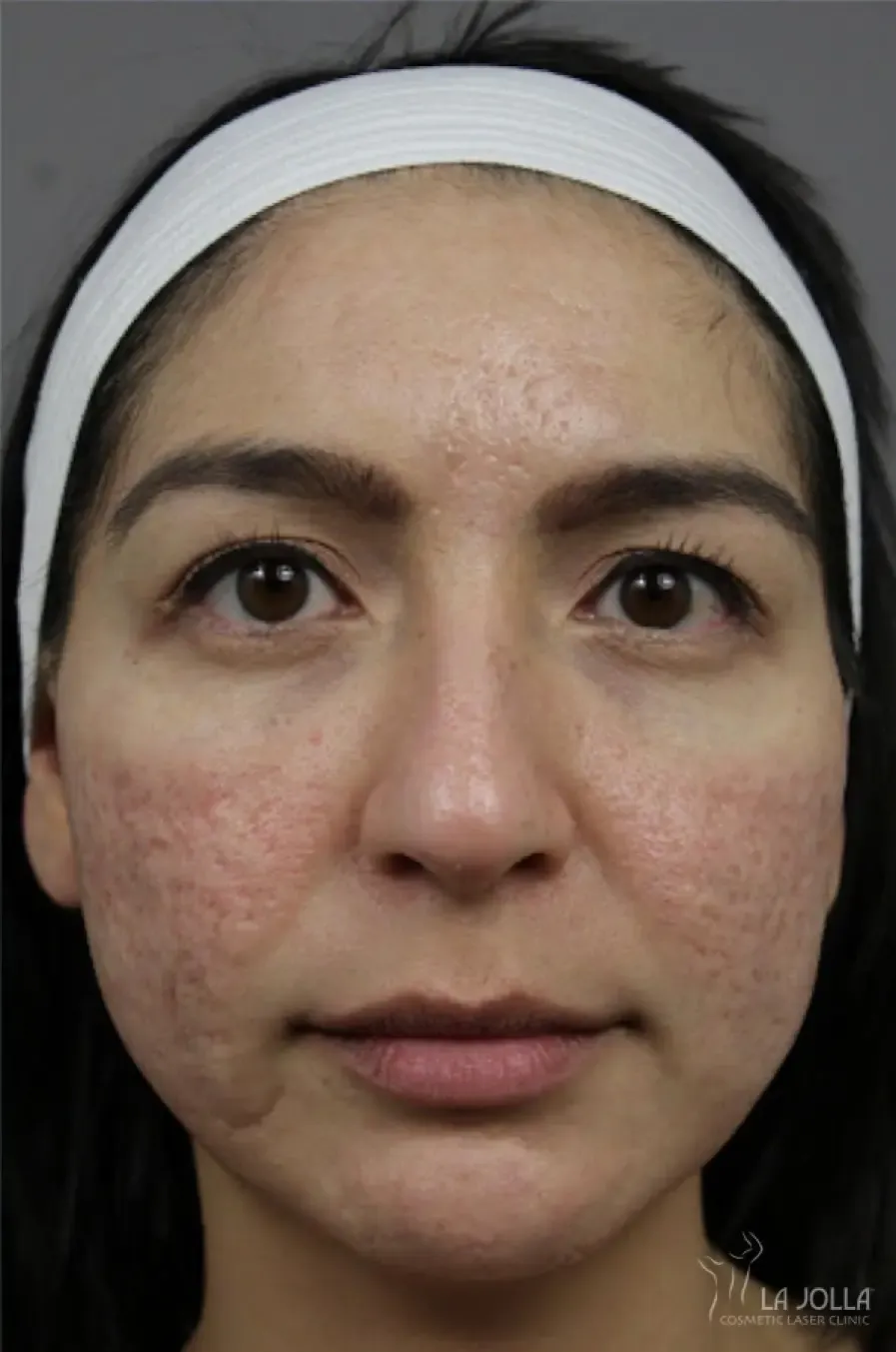 Acne Scarring