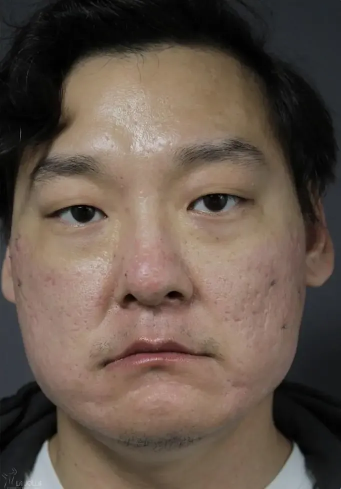 Acne Scarring
