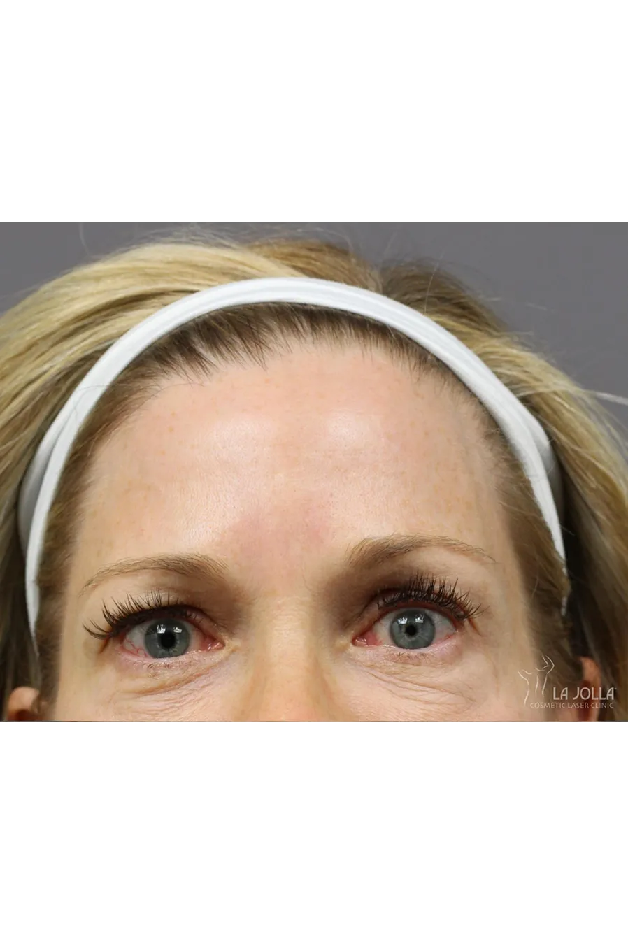 BOTOX & Wrinkle Relaxers
