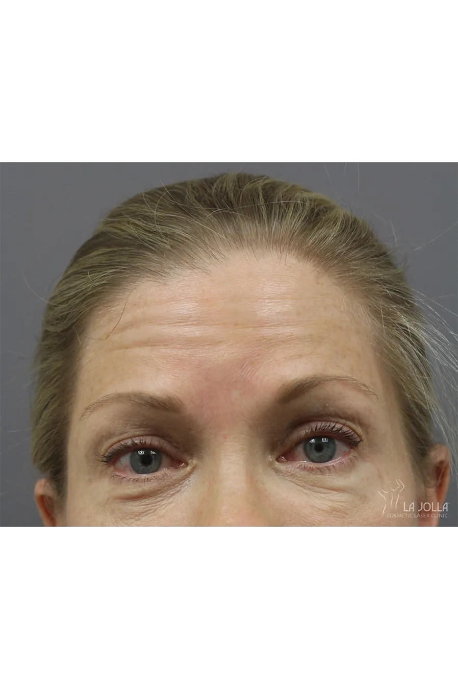 BOTOX & Wrinkle Relaxers