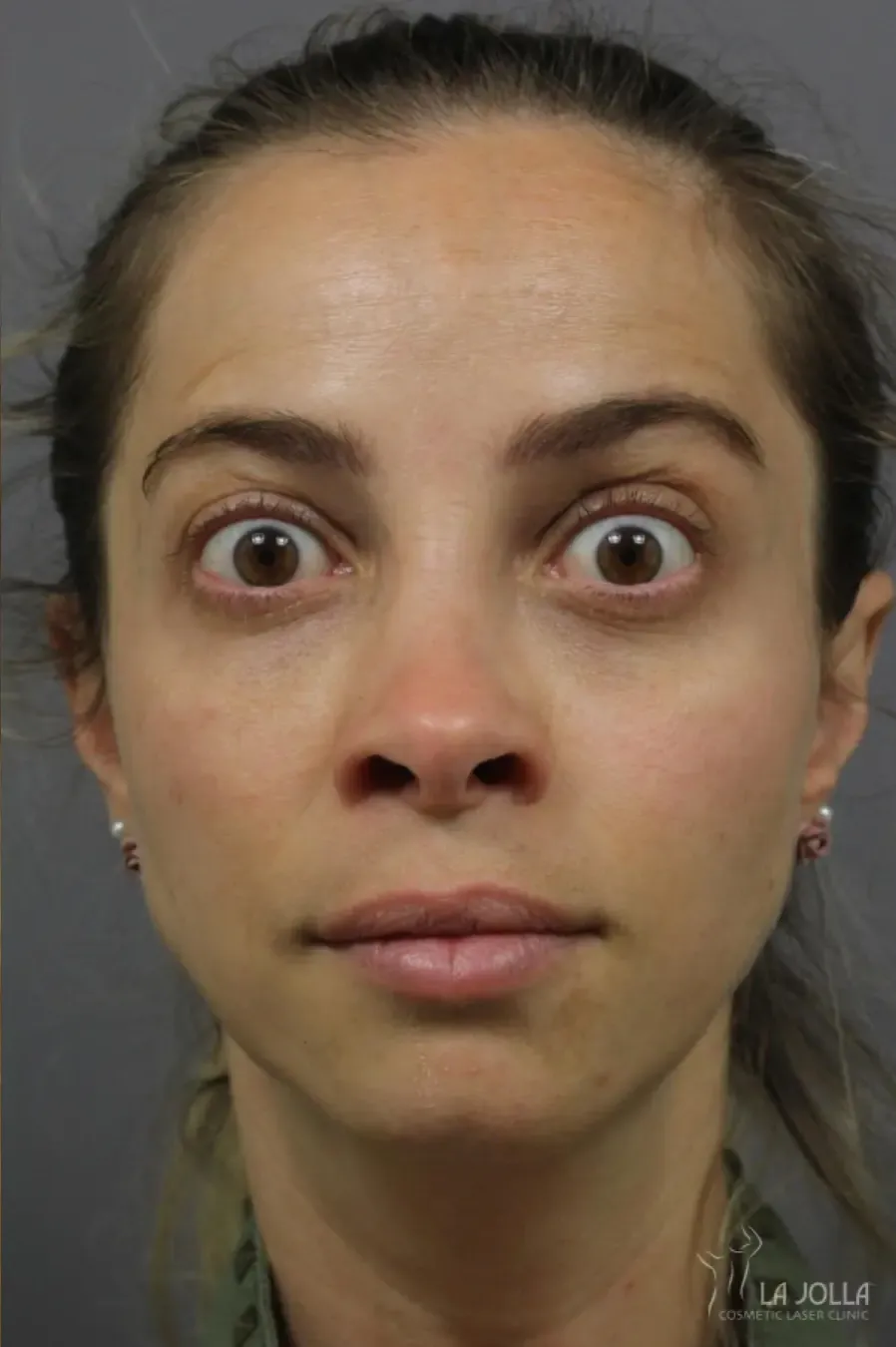 BOTOX & Wrinkle Relaxers