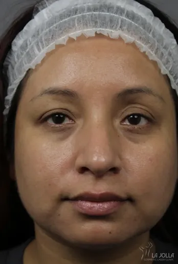 Chemical Peels