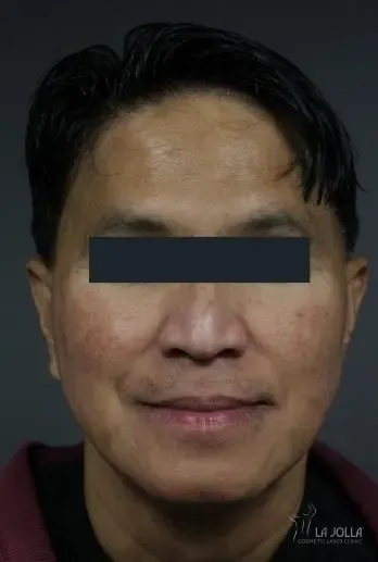 Chemical Peels