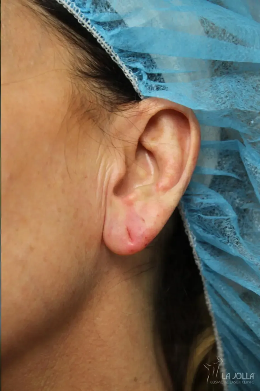 Dermal Fillers
