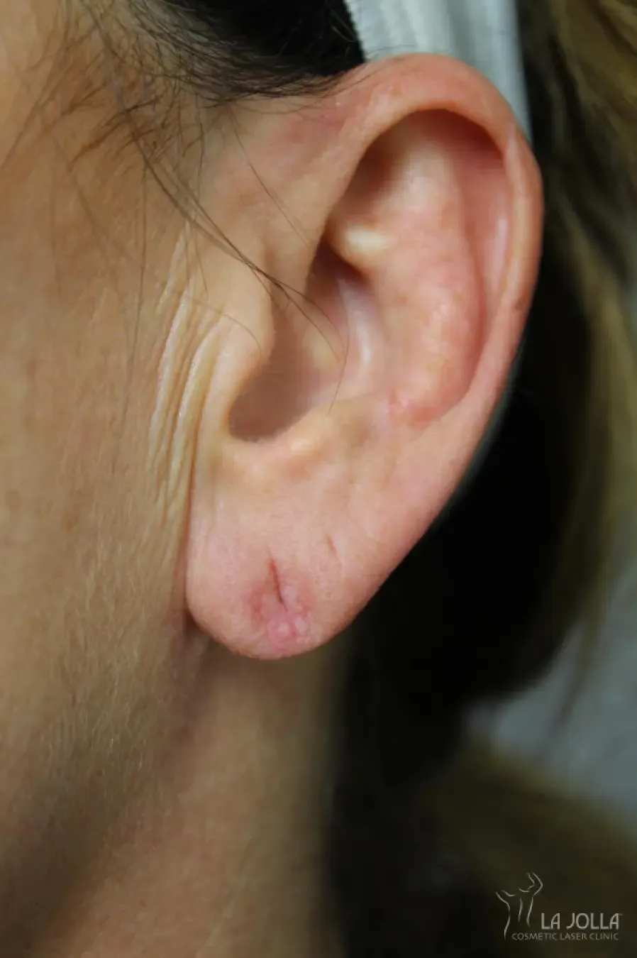 Dermal Fillers