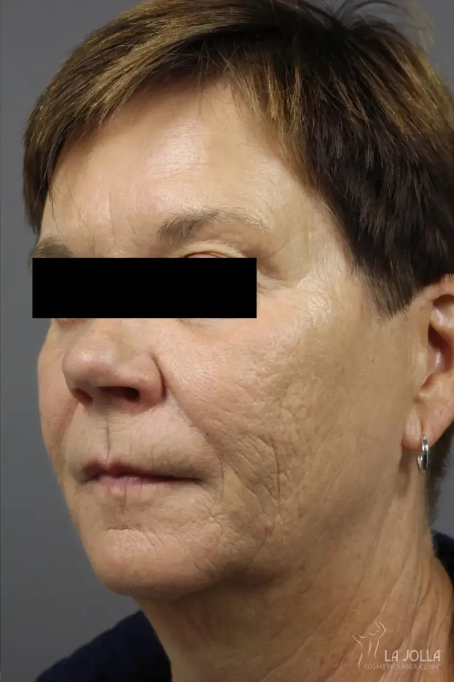 Dermal Fillers