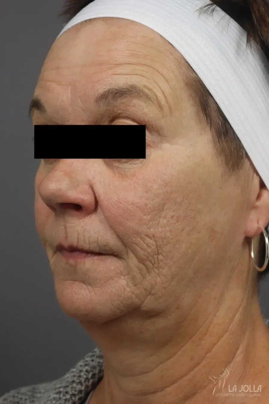 Dermal Fillers