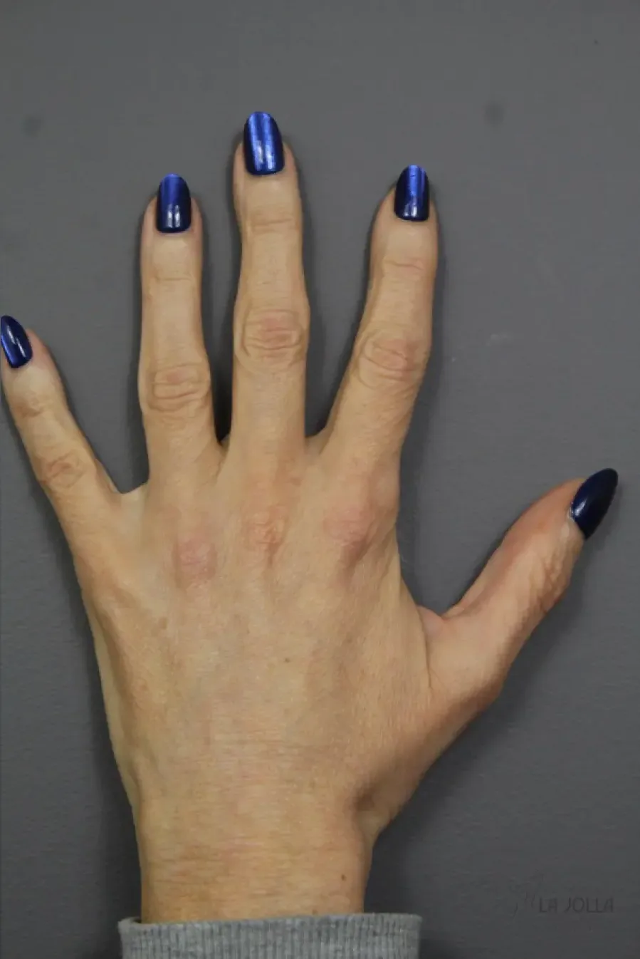 Radiesse Hand Rejuvenation