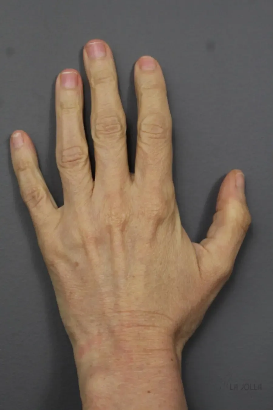 Radiesse Hand Rejuvenation