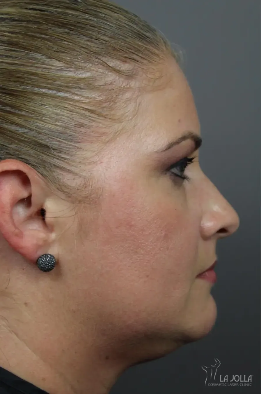 Kybella