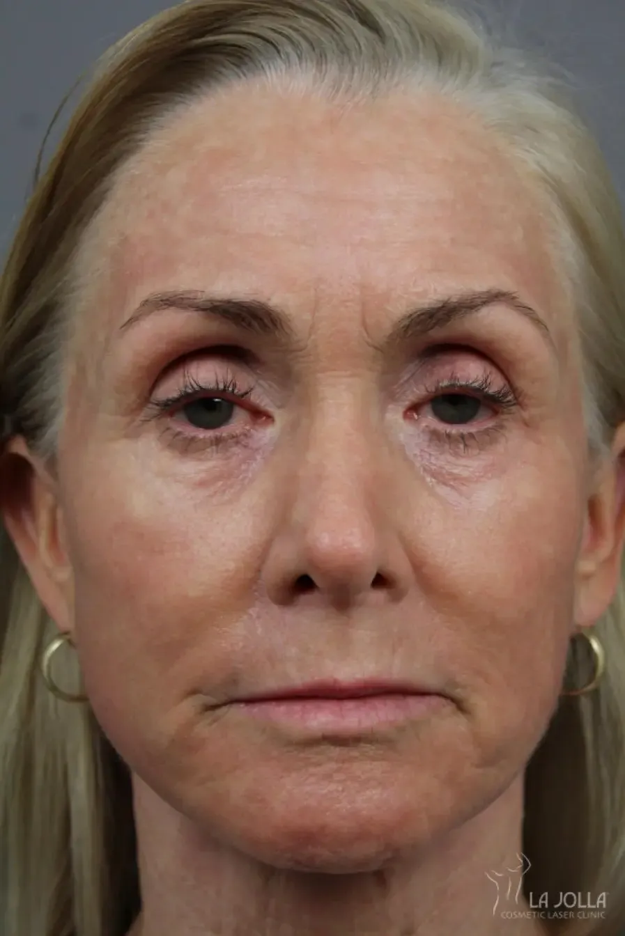 Laser Skin Resurfacing