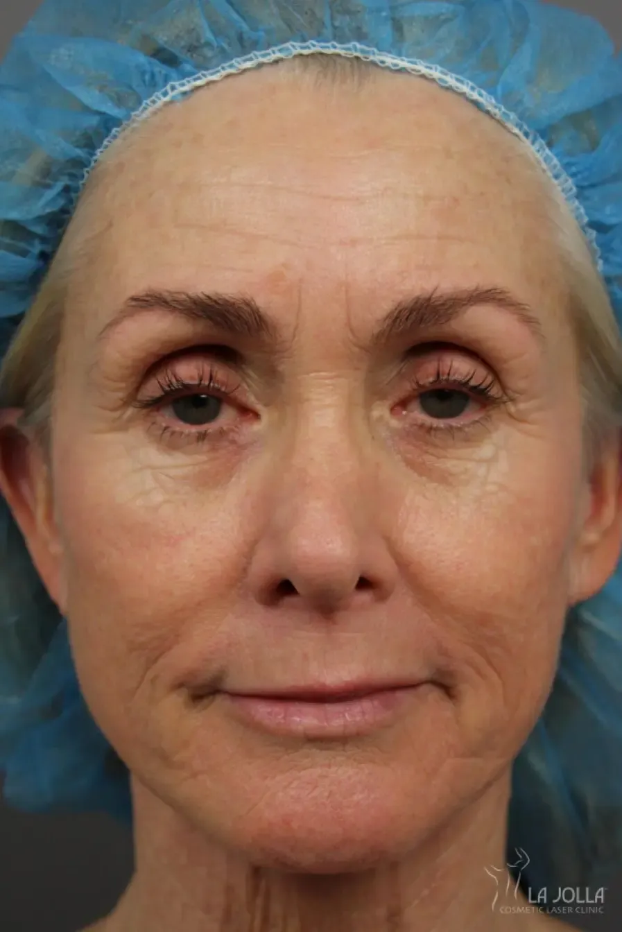 Laser Skin Resurfacing