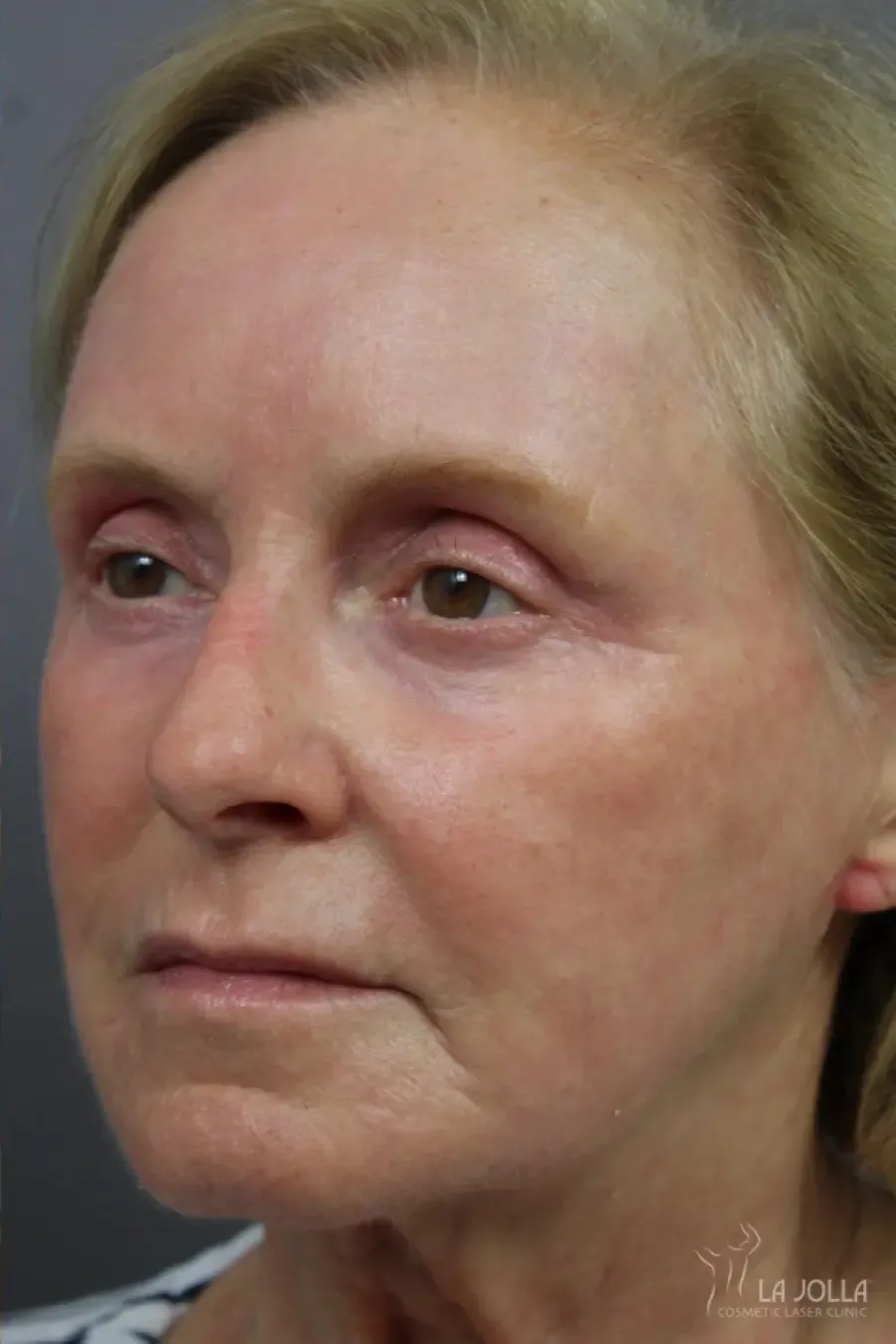 Laser Skin Resurfacing