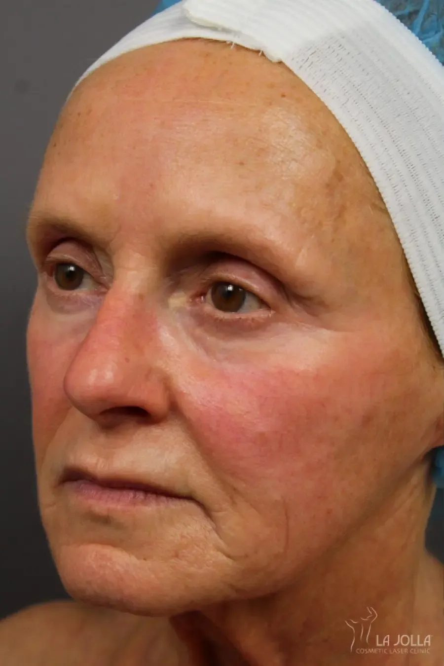 Laser Skin Resurfacing