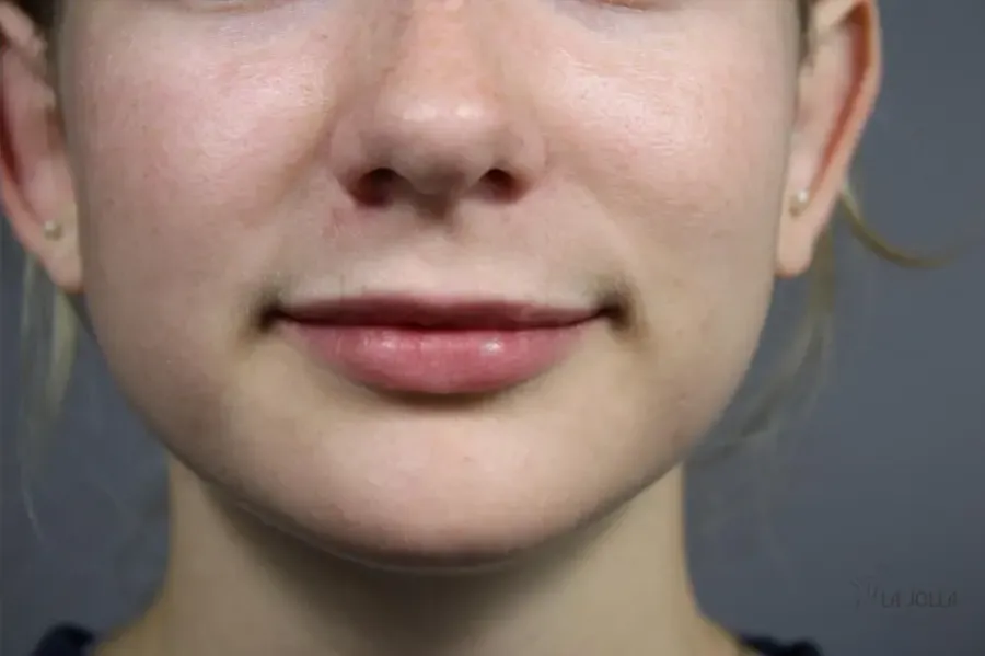 Lip Fillers