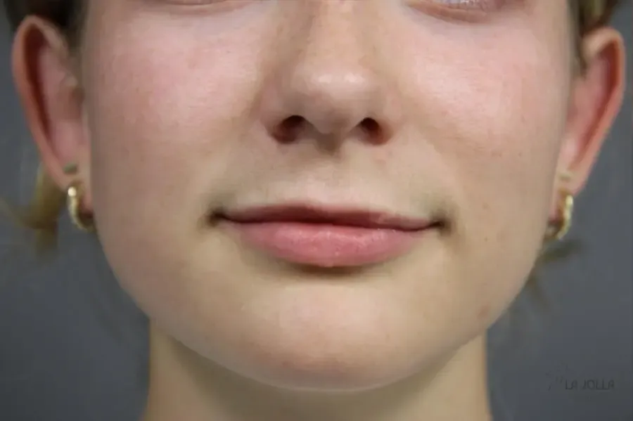 Lip Fillers