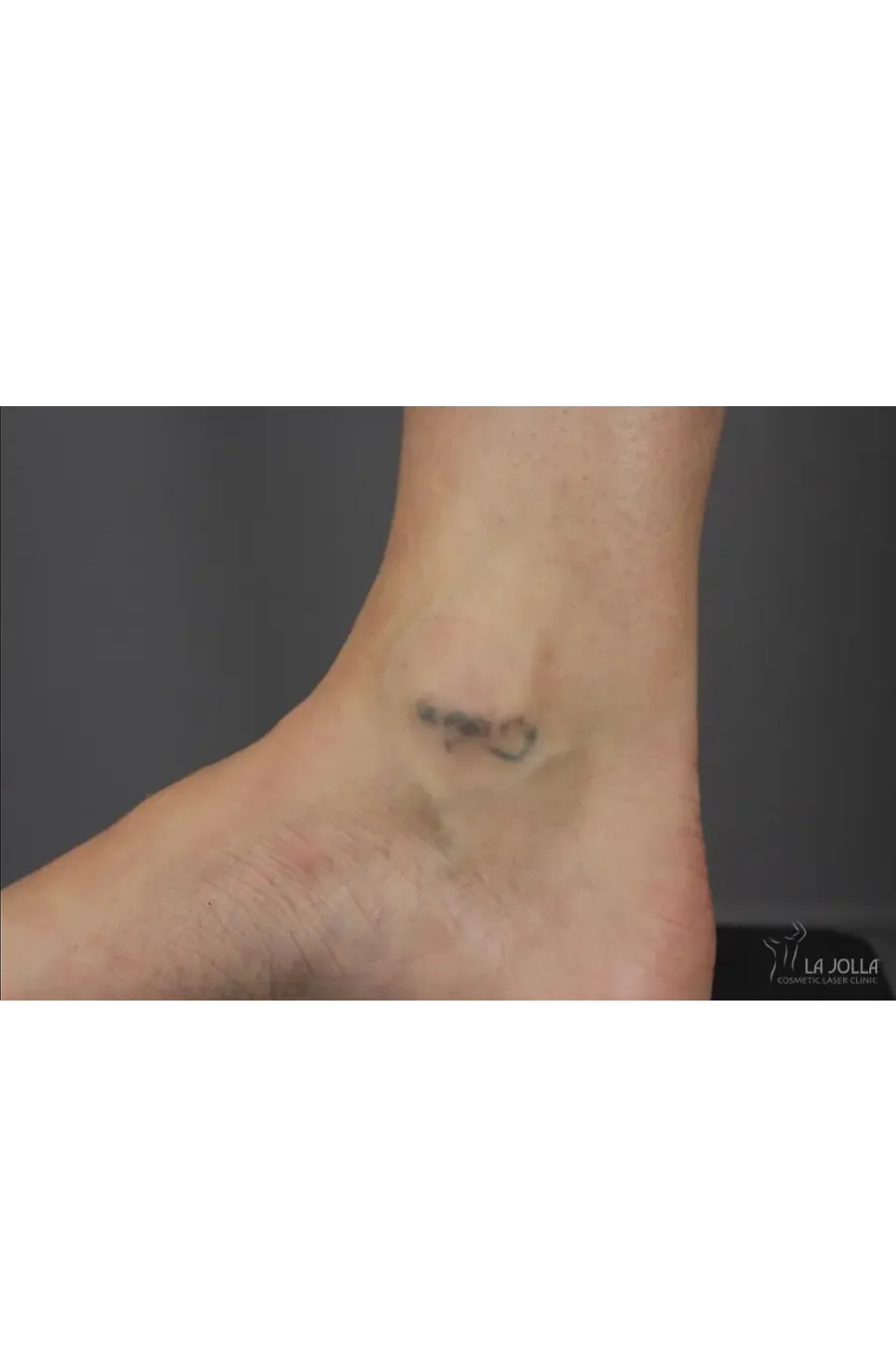 Laser Tattoo Removal