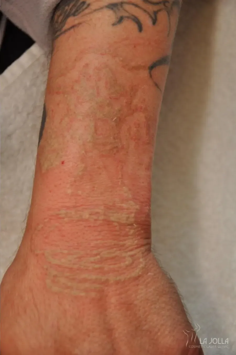 Laser Tattoo Removal