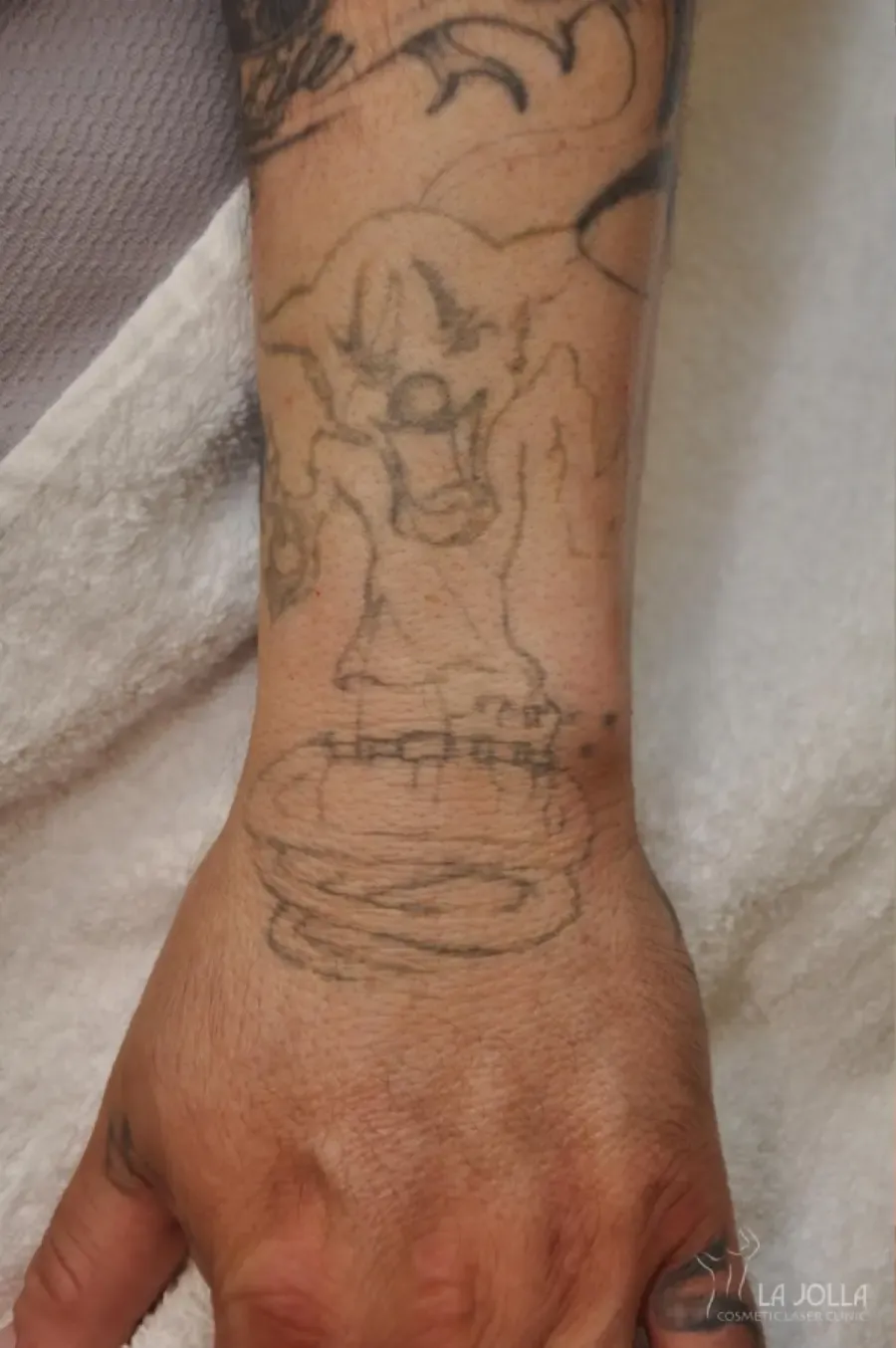 Laser Tattoo Removal