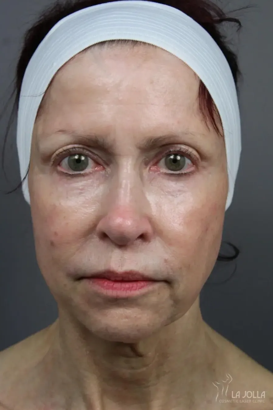 6D Platinum Laser Lift