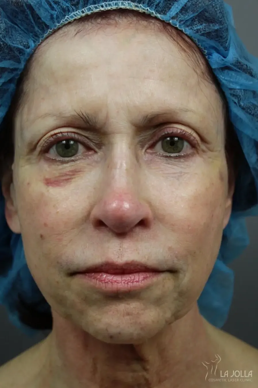 6D Platinum Laser Lift