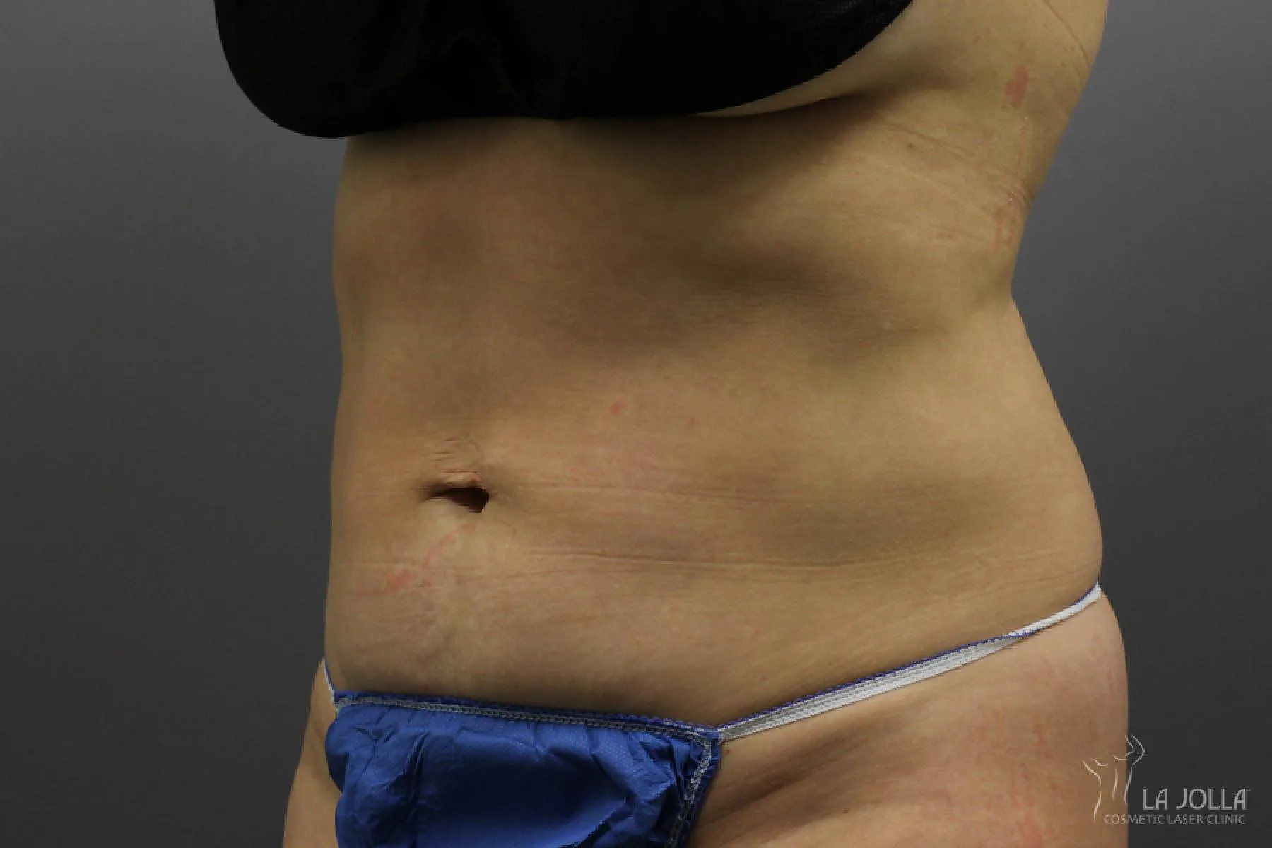 CoolSculpting