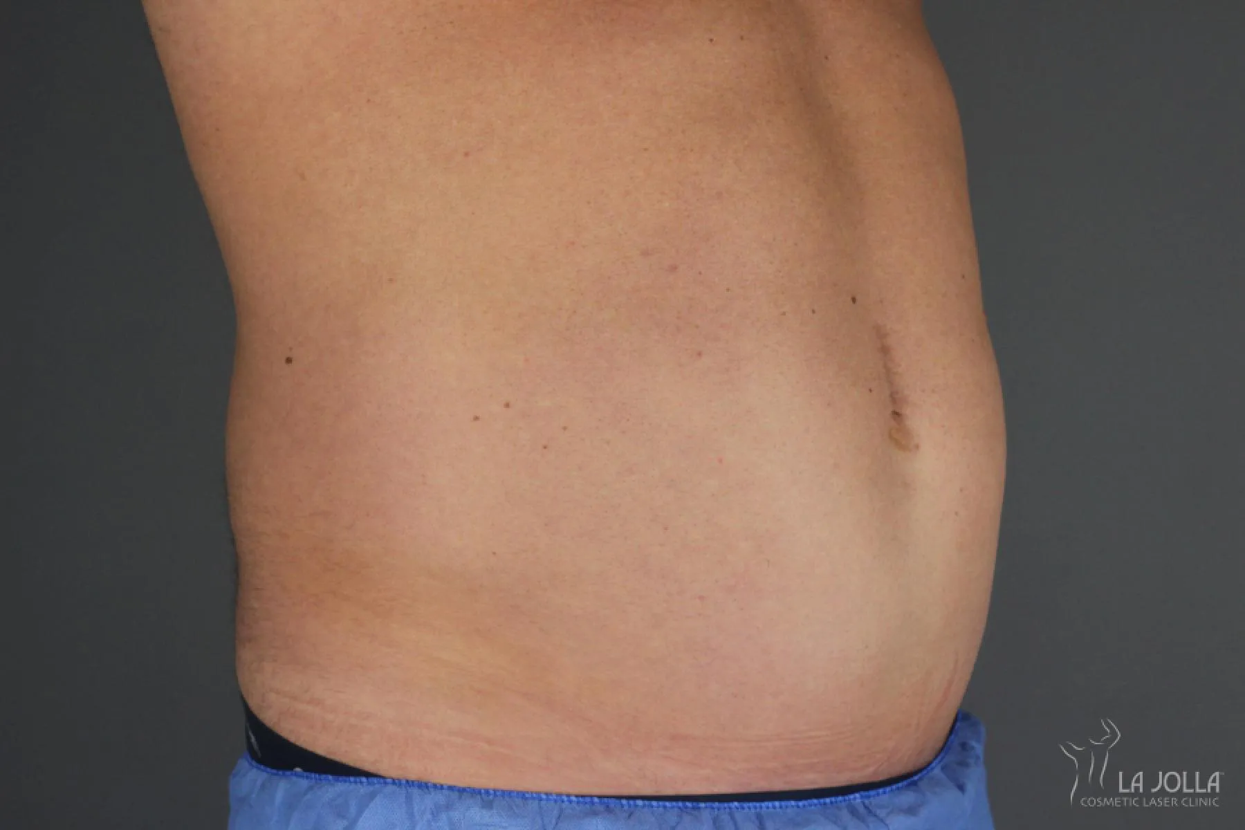 CoolSculpting
