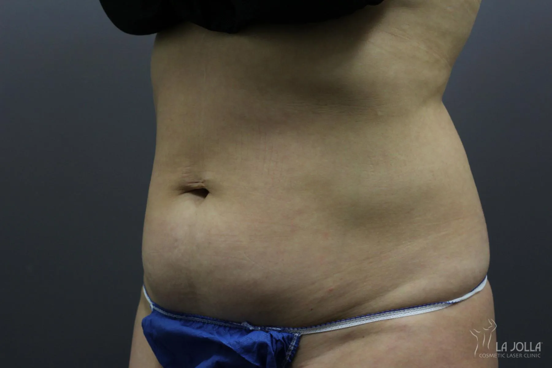 CoolSculpting