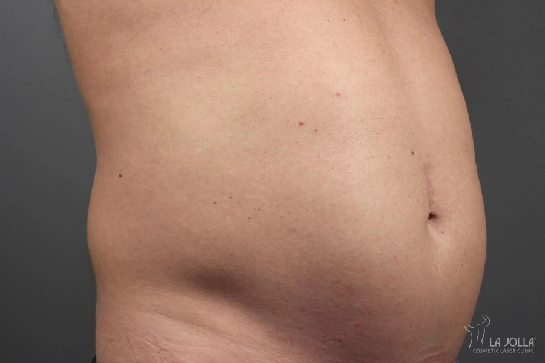 CoolSculpting