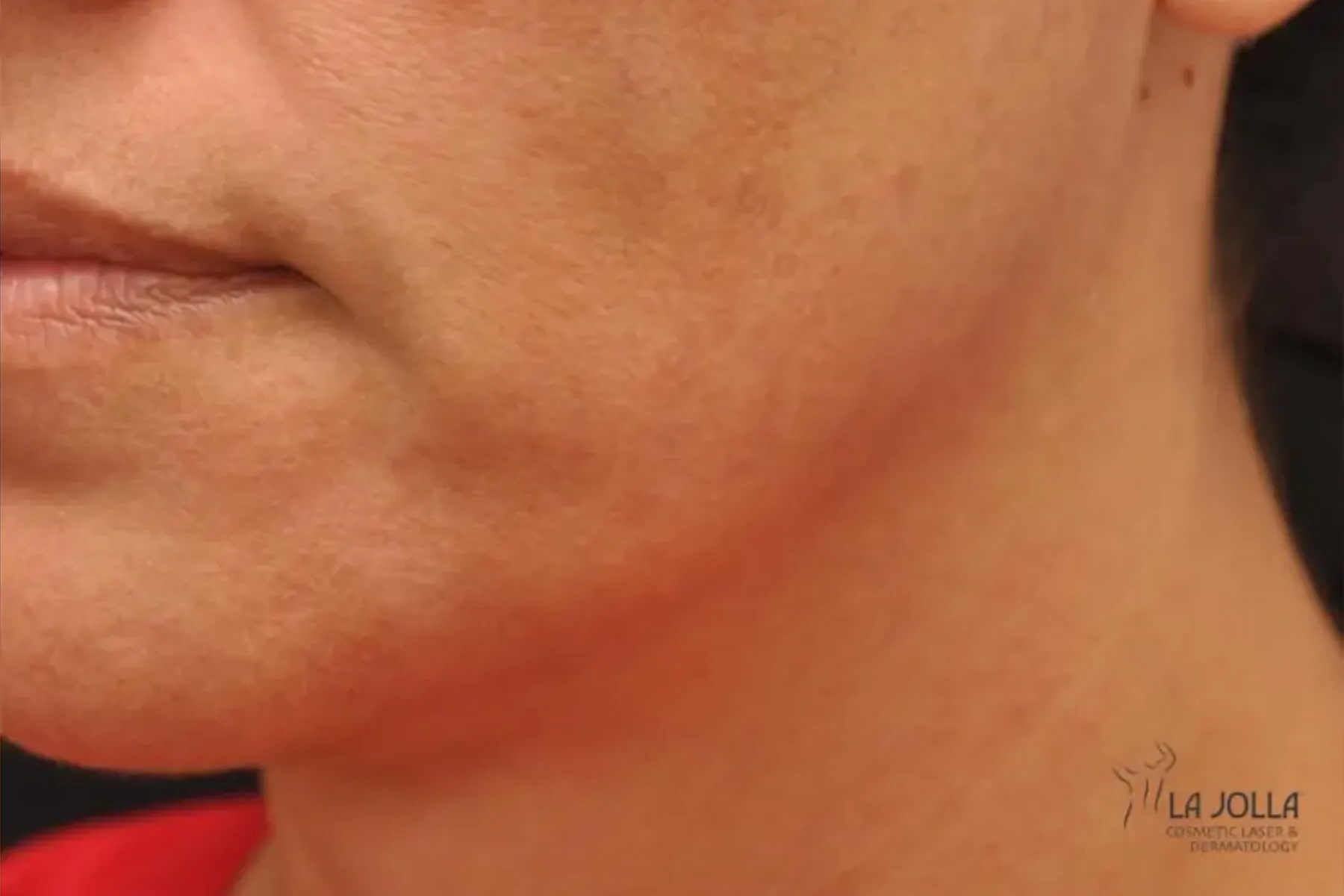 IPL PhotoFacial