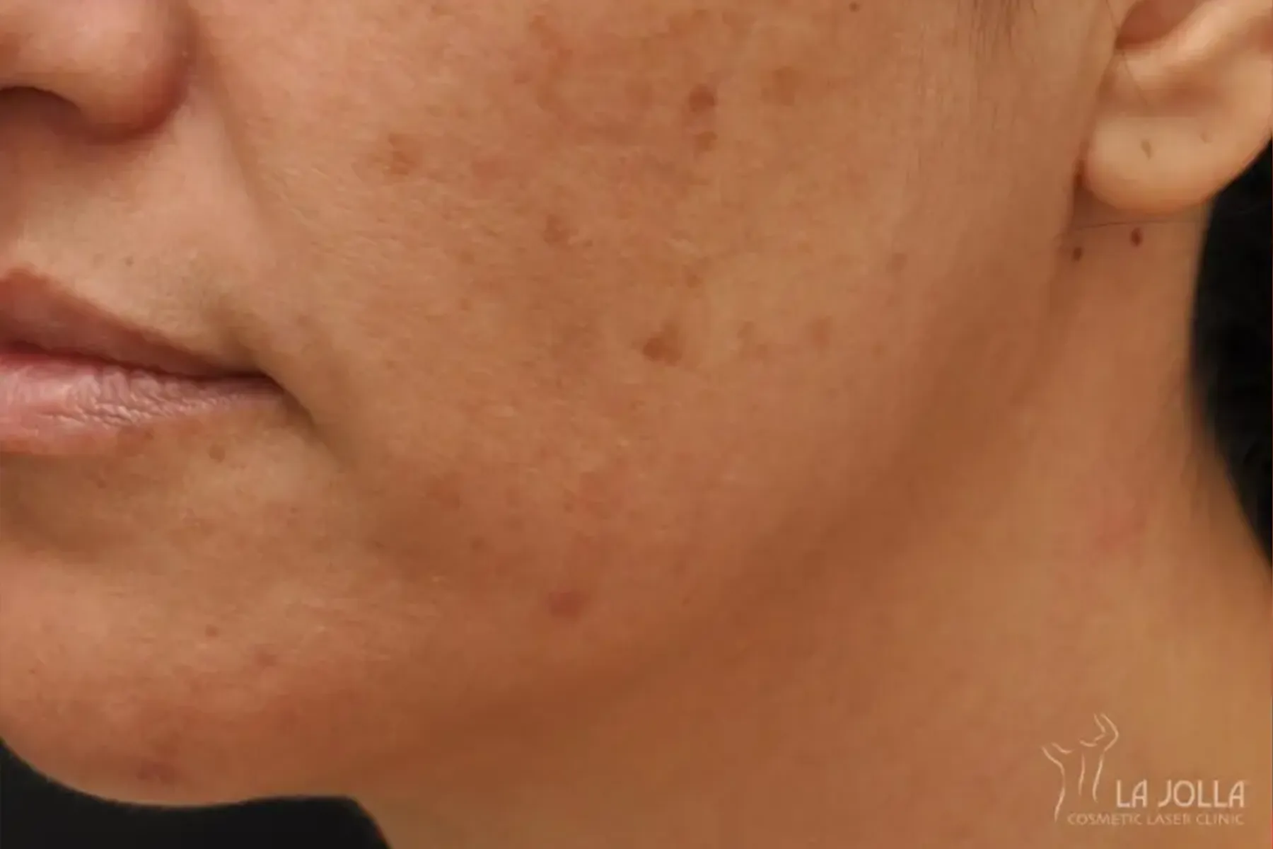 IPL PhotoFacial