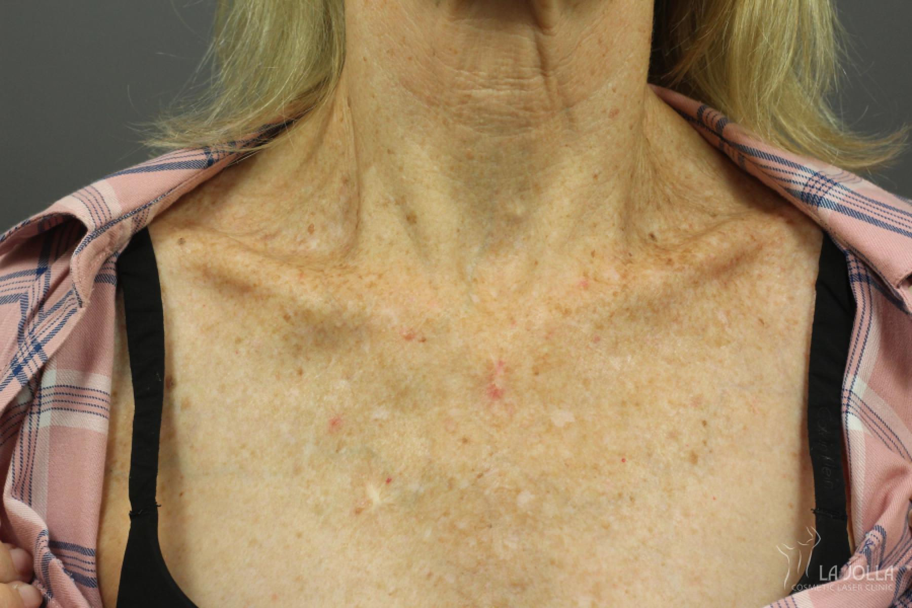 IPL PhotoFacial