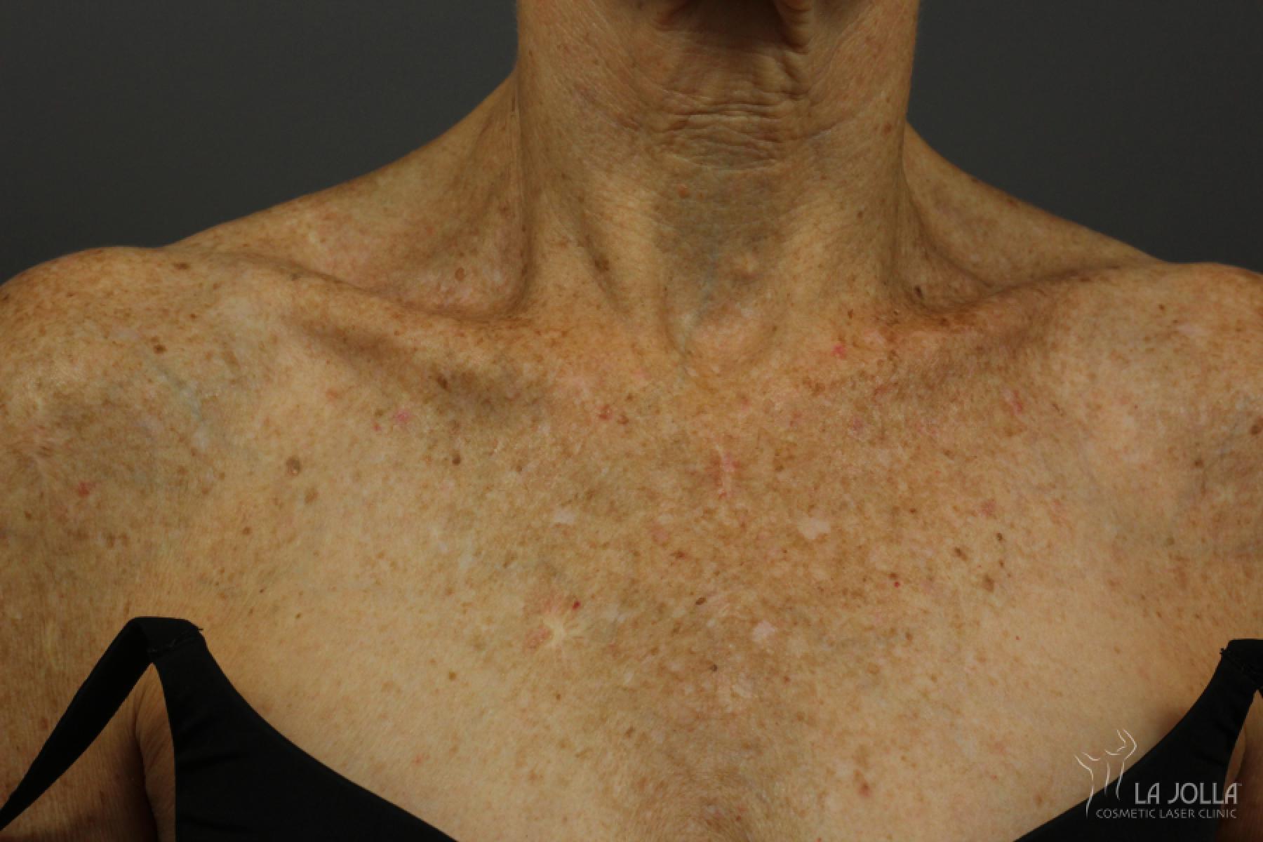 IPL PhotoFacial