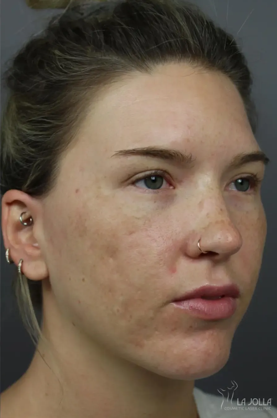 Acne Scars (Laser)