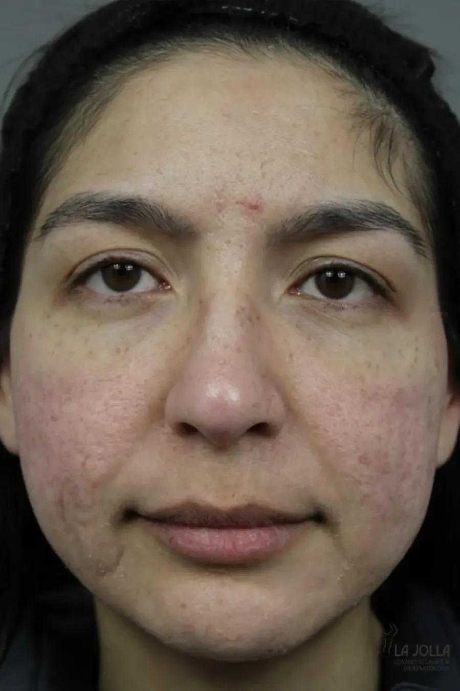 Acne Scar Release (Subcision with Laser)