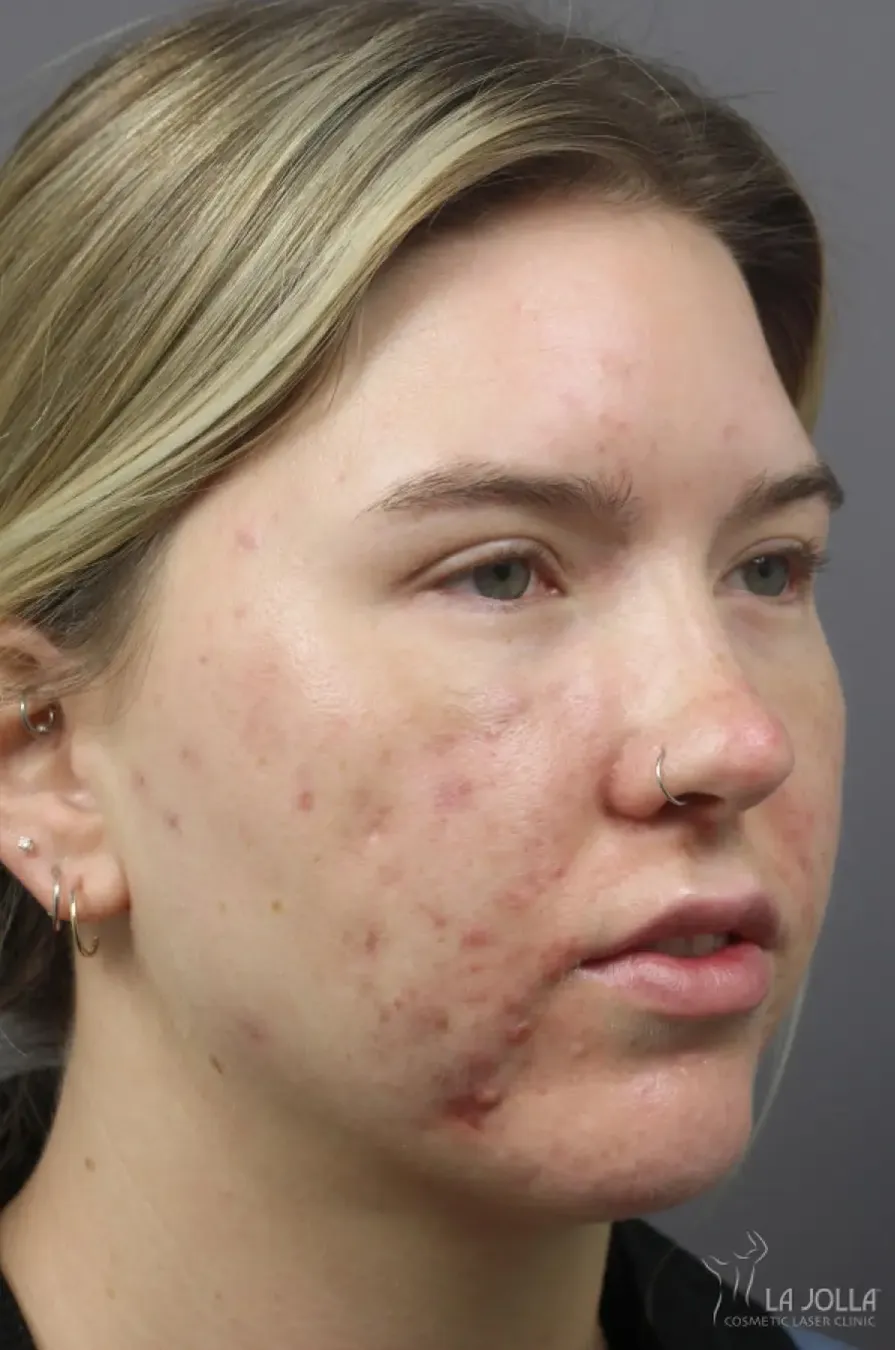 Acne Scars (Laser)