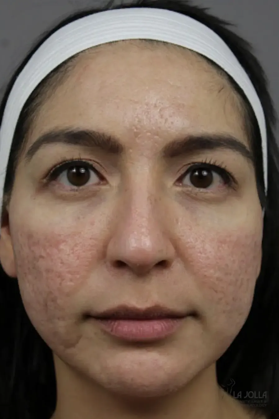 Acne Scar Release (Subcision with Laser)