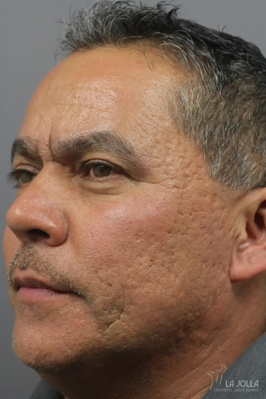 Acne Scar Release (Subcision with Laser)