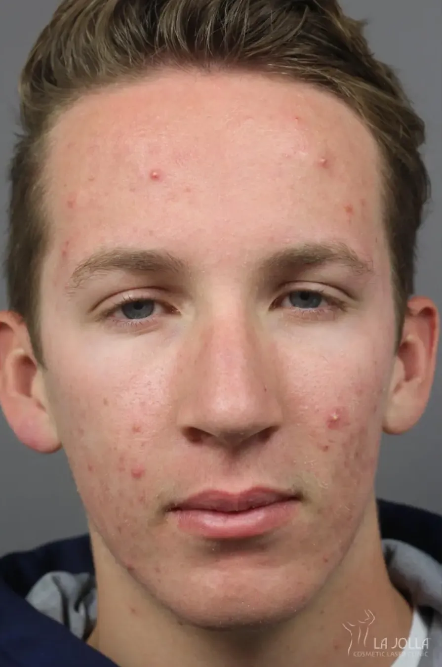 Acne Scars (Laser)