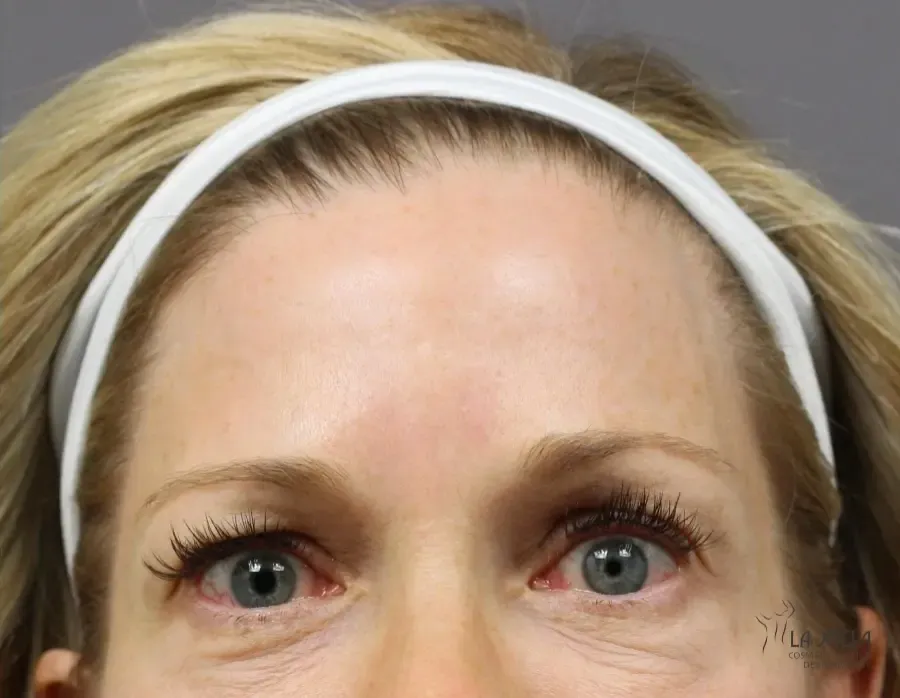 BOTOX & Wrinkle Relaxers